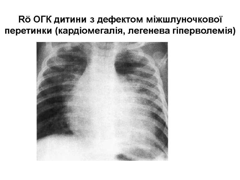 Rö ОГК дитини з дефектом міжшлуночкової перетинки (кардіомегалія, легенева гіперволемія)